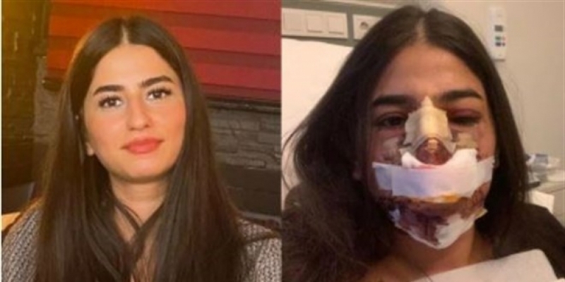 Avusturya’dan Burun Estetiği Yaptırmak İçin İstanbul’a Gitti, Hayatının Şokunu Yaşadı