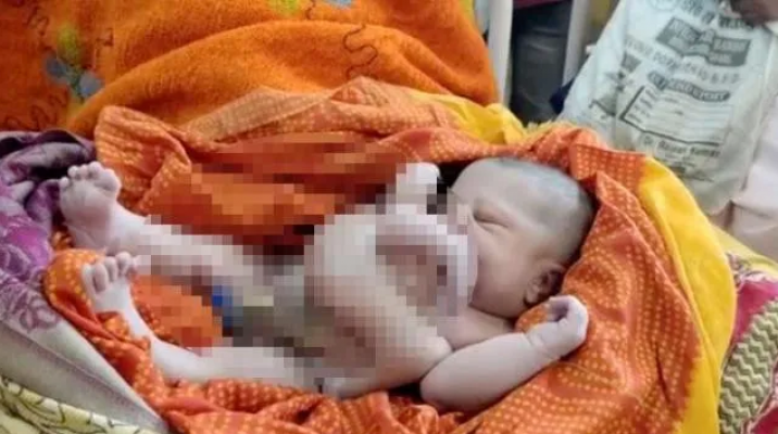 Dört kollu ve dört bacaklı bir bebek dünyaya geldi